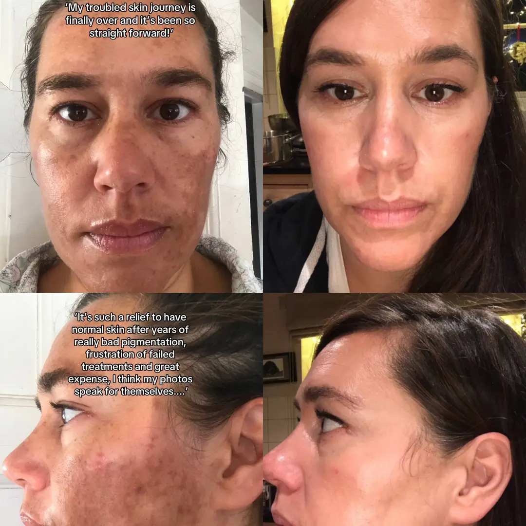 Patient Story E
